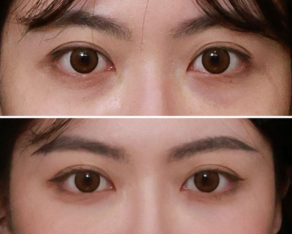 案例 新願美學診所（郭毅昕醫師｜台北醫美推薦｜台北海芙音波媚必提｜海芙電波｜海菲秀｜探索皮秒｜喬雅登｜熊貓針推薦）