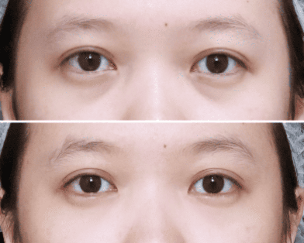 案例 新願美學診所（郭毅昕醫師｜台北醫美推薦｜台北海芙音波媚必提｜海芙電波｜海菲秀｜探索皮秒｜喬雅登｜熊貓針推薦）