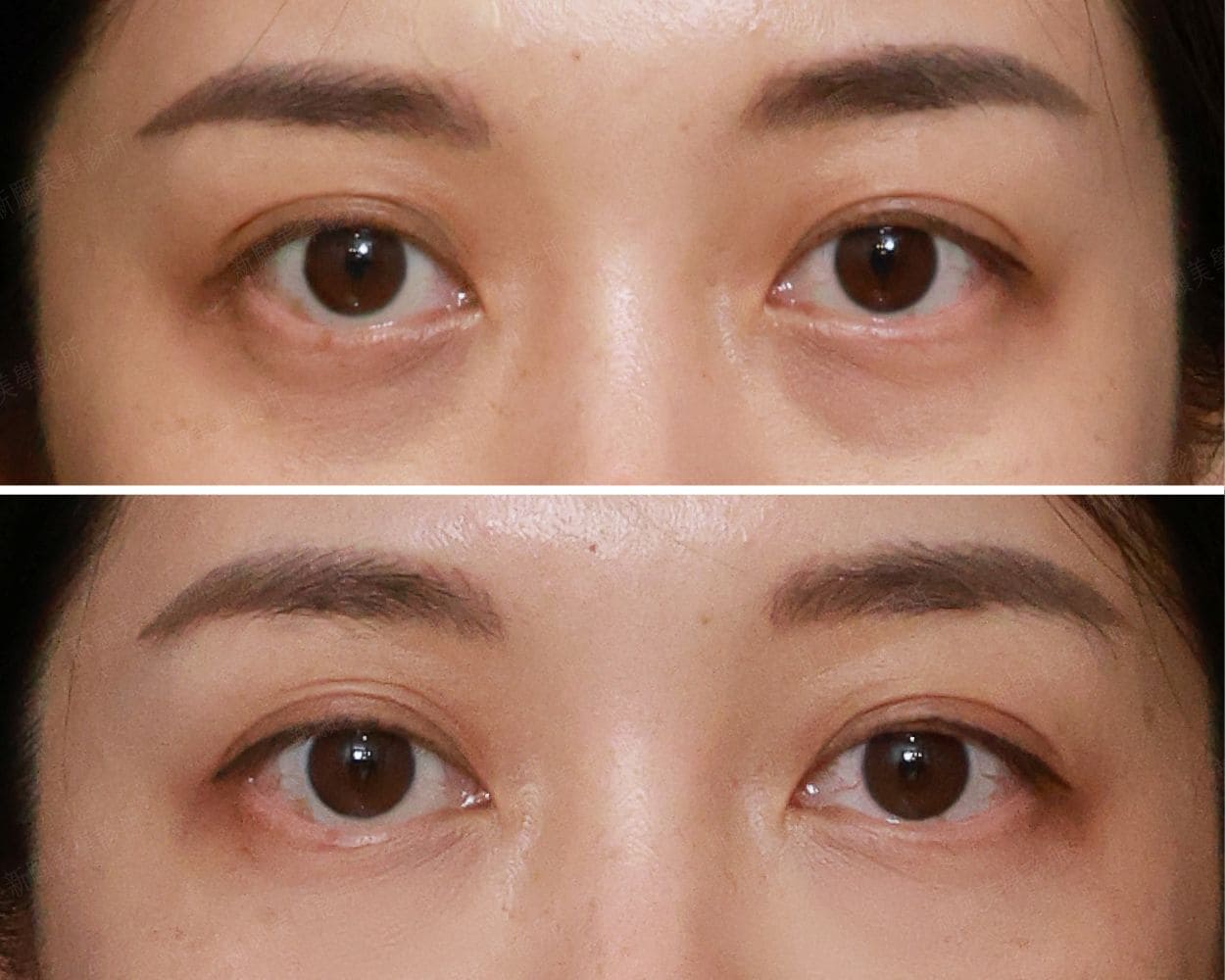 案例 新願美學診所（郭毅昕醫師｜台北醫美推薦｜台北海芙音波媚必提｜海芙電波｜海菲秀｜探索皮秒｜喬雅登｜熊貓針推薦）