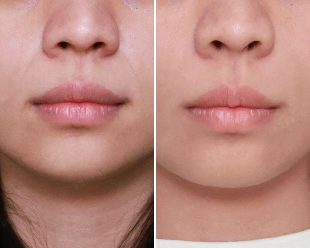 法令紋 新願美學診所（郭毅昕醫師｜台北醫美推薦｜台北海芙音波媚必提｜海芙電波｜海菲秀｜探索皮秒｜喬雅登｜熊貓針推薦）