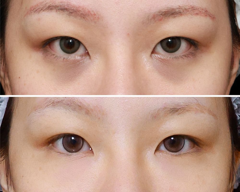 淚溝 新願美學診所（郭毅昕醫師｜台北醫美推薦｜台北海芙音波媚必提｜海芙電波｜海菲秀｜探索皮秒｜喬雅登｜熊貓針推薦）