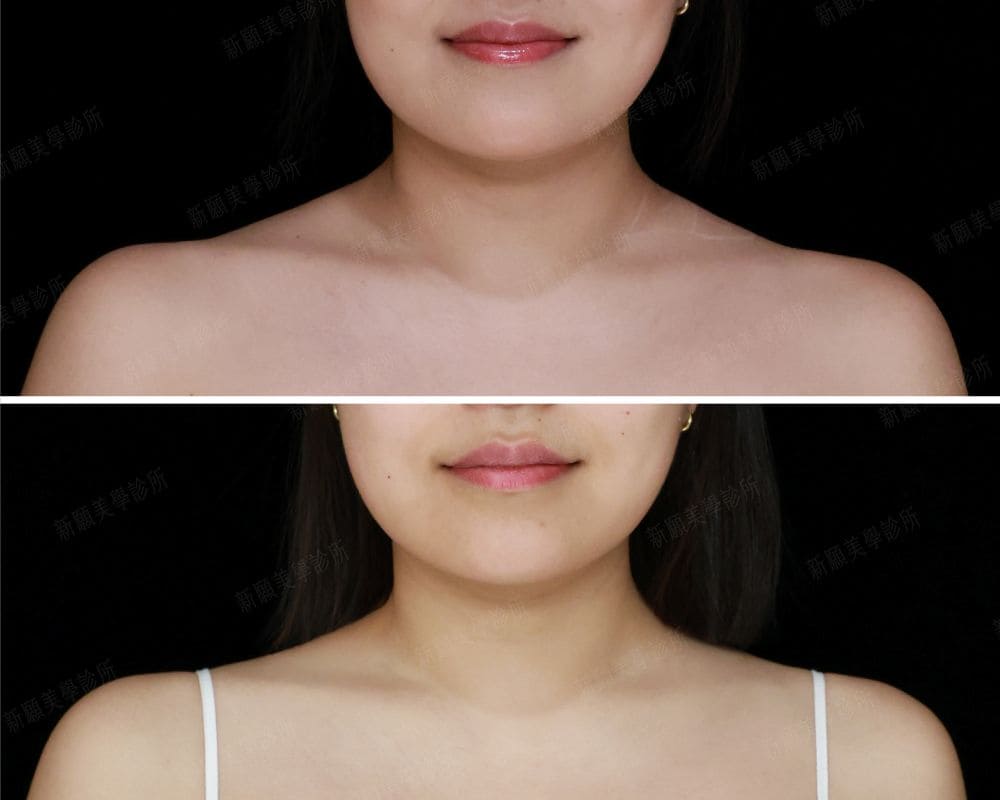 肩膀 新願美學診所（郭毅昕醫師｜台北醫美推薦｜台北海芙音波媚必提｜海芙電波｜海菲秀｜探索皮秒｜喬雅登｜熊貓針推薦）