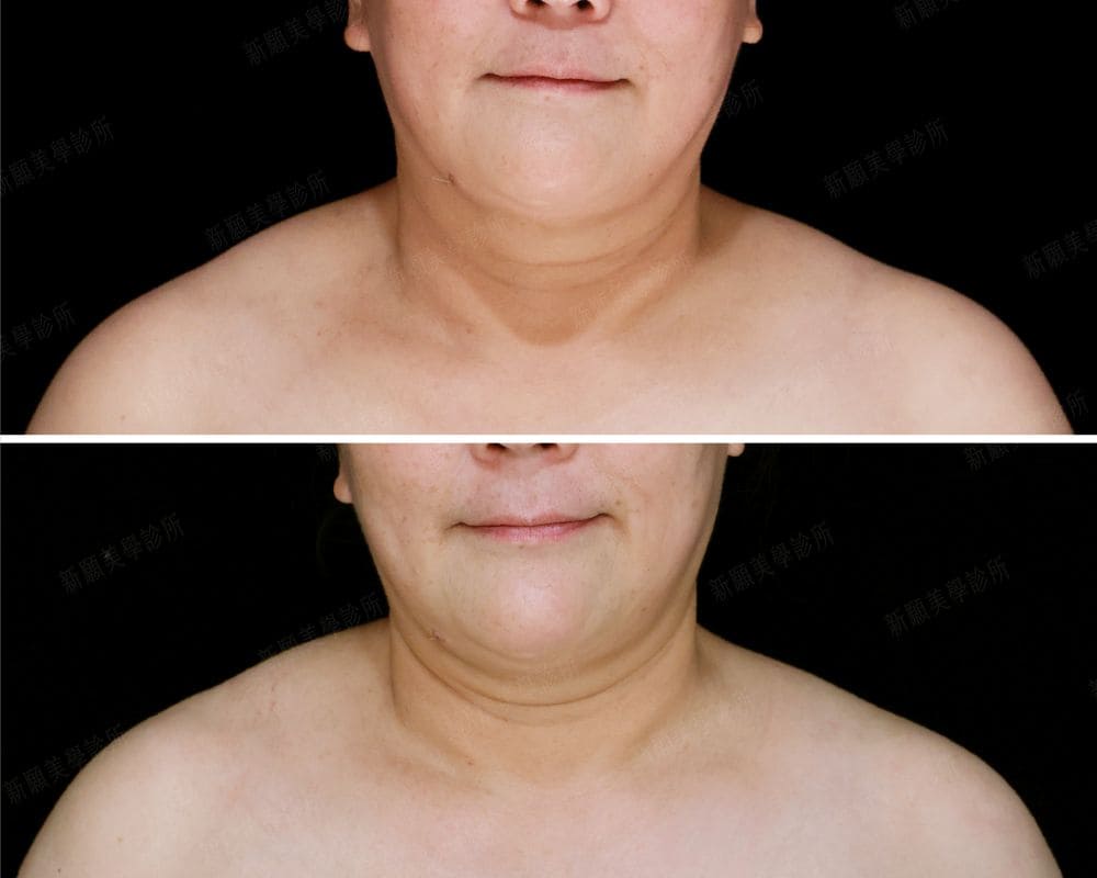 肩膀 新願美學診所（郭毅昕醫師｜台北醫美推薦｜台北海芙音波媚必提｜海芙電波｜海菲秀｜探索皮秒｜喬雅登｜熊貓針推薦）