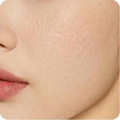 德瑪莎水光針-新願美學診所（郭毅昕醫師｜台北醫美推薦｜台北海芙音波媚必提｜海芙電波｜海菲秀｜探索皮秒｜喬雅登｜熊貓針推薦）