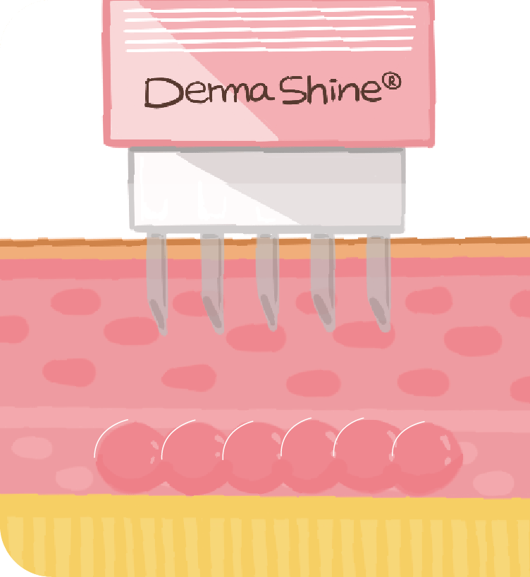 水光針治療原理-新願美學診所（郭毅昕醫師｜台北醫美推薦｜台北海芙音波媚必提｜海芙電波｜海菲秀｜探索皮秒｜喬雅登｜熊貓針推薦）