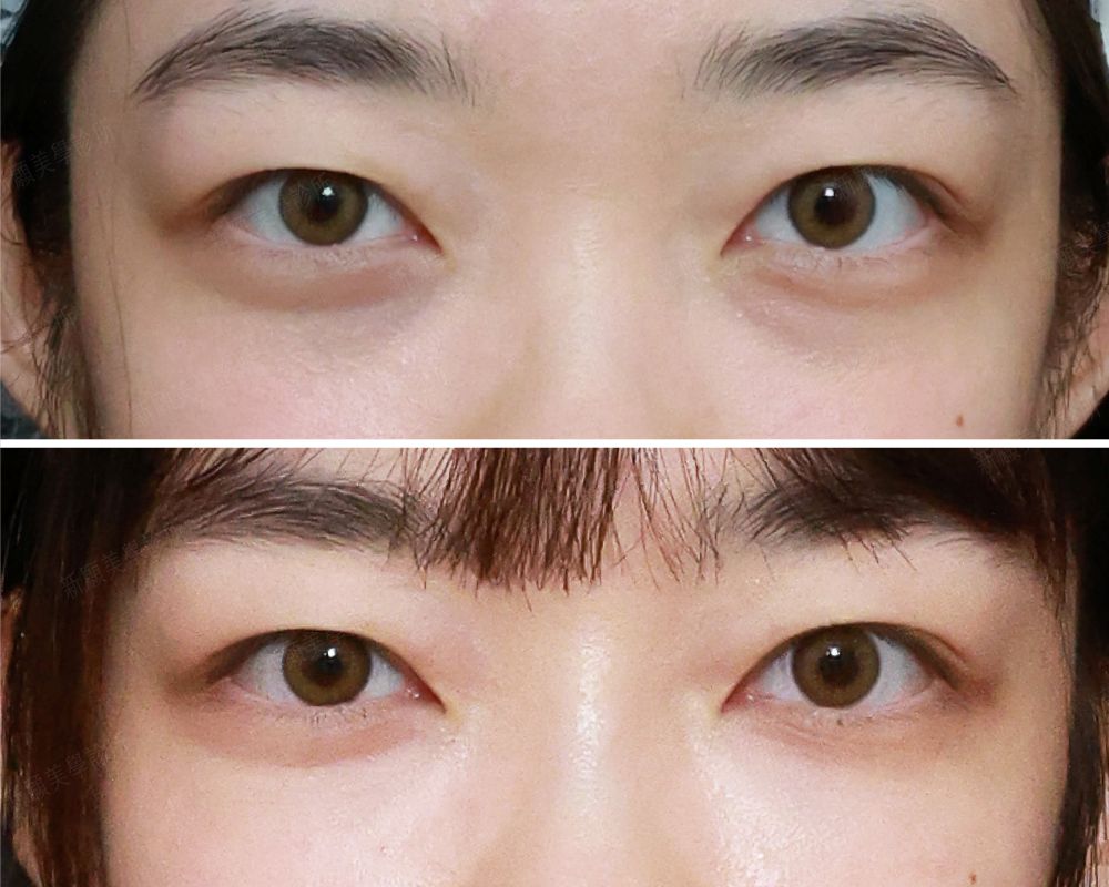 淚溝 新願美學診所（郭毅昕醫師｜台北醫美推薦｜台北海芙音波媚必提｜海芙電波｜海菲秀｜探索皮秒｜喬雅登｜熊貓針推薦）