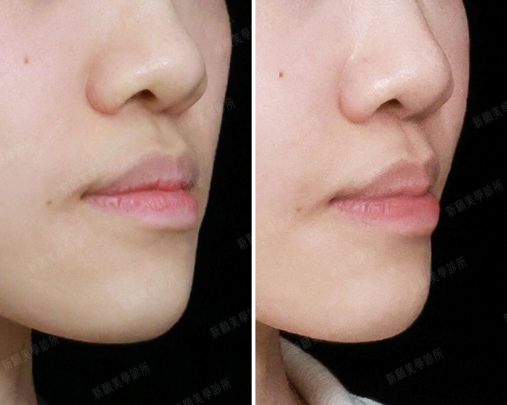 豐唇 新願美學診所（郭毅昕醫師｜台北醫美推薦｜台北海芙音波媚必提｜海芙電波｜海菲秀｜探索皮秒｜喬雅登｜熊貓針推薦）