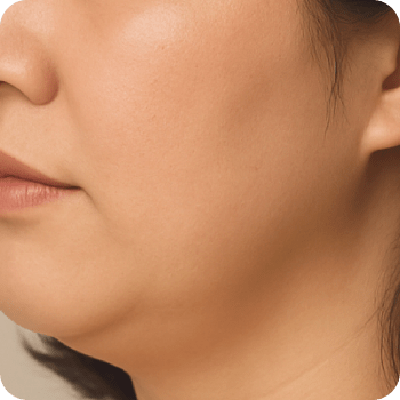 海芙電波 - 新願美學診所（郭毅昕醫師｜台北醫美推薦｜台北海芙音波媚必提｜海芙電波｜海菲秀｜探索皮秒｜喬雅登｜熊貓針推薦）