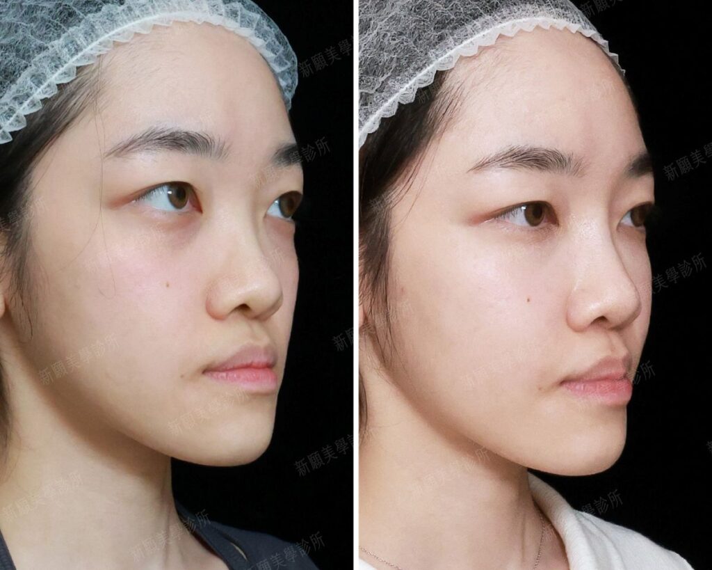 鼻雕 新願美學診所（郭毅昕醫師｜台北醫美推薦｜台北海芙音波媚必提｜海芙電波｜海菲秀｜探索皮秒｜喬雅登｜熊貓針推薦）