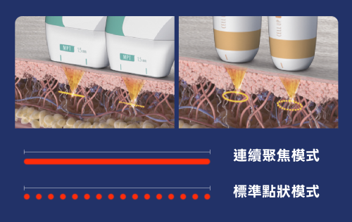 海芙音波旗艦機「媚必提」效果強在哪？價格、效果、獨家探頭大公開